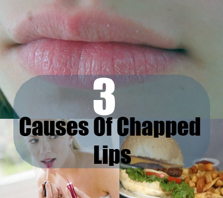 How To Get Rid Of Chapped Lips Common Causes Of Chapped Lips