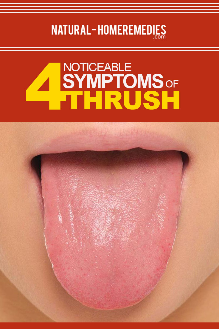 Various Noticeable Symptoms Of Thrush Tips To Identify Symptoms Of 