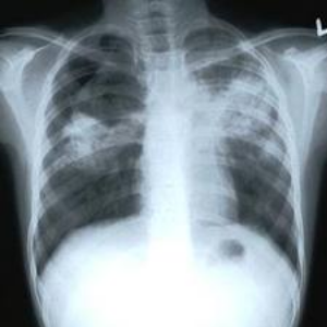  - Some-Other-Common-Symptoms-Of-Tuberculosis