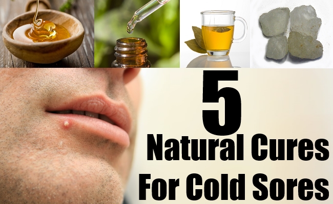 home remedies for cold sores