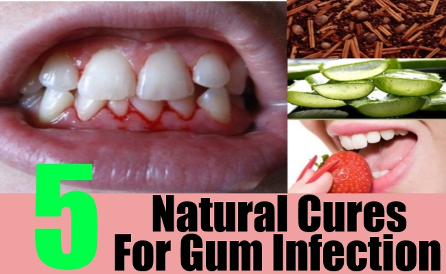 Treat Cold Sores Fast How To Cure Infection In Gums