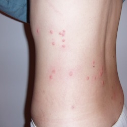 Typhus Symptoms And Treatment - How To Treat Typhus Symptoms | Natural