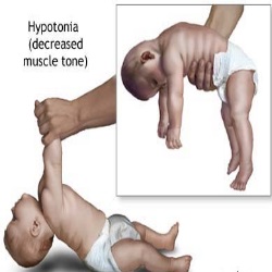 hypotonia