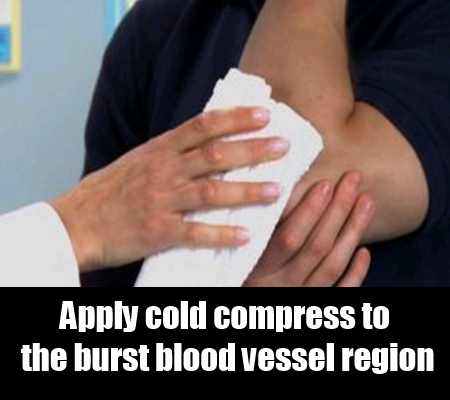 hemorrhoids cold compress