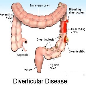 Diverticulosis Symptoms