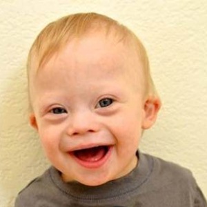 7 Down Syndrome Symptoms That You Must Know - How To Recognize The ...