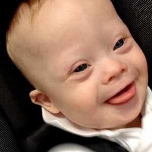 7 Down Syndrome Symptoms That You Must Know - How To Recognize The ...