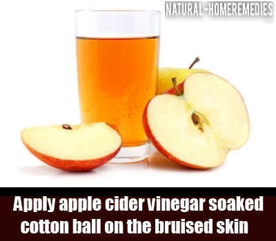 Top 6 Home Remedies For Bruises - Natural Treatments And Cures For ...