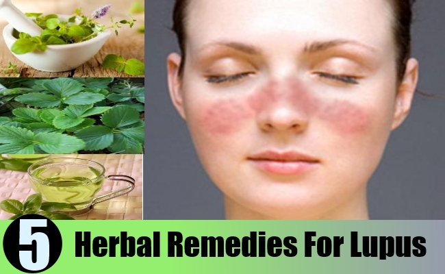 Herbal Remedies For Lupus
