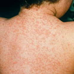 Top 6 Home Remedies For Measles - Natural Treatments And Cures For ...