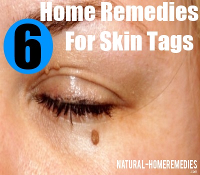 6 Effective Home Remedies For Skin Tags - Natural Remedy, Treatments ...