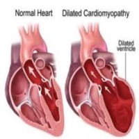 Enlarged Heart Causes, Symptoms, And Treatment - Signs Of Enlarged ...