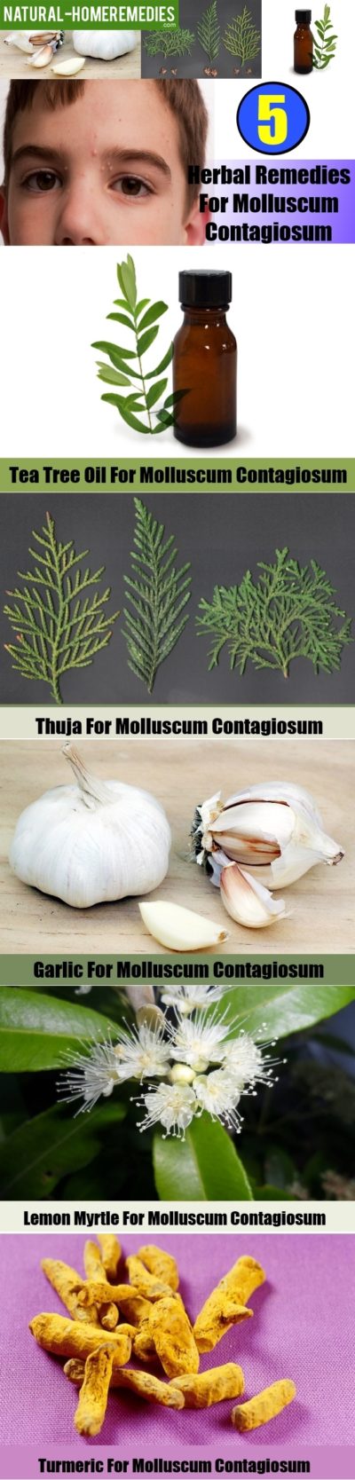 Best Herbal Remedies To Get Rid Of Molluscum Contagiosum Natural Home Remedies And Supplements