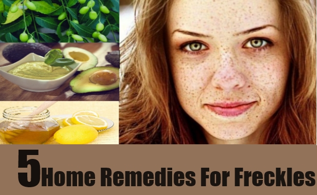 5 Home Remedies For Freckles