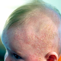 Top 5 Herbal Remedies For Cradle Cap - How To Get Rid Of | Natural Home ...