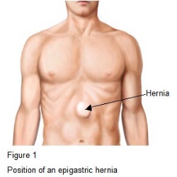 5 Best Herbal Remedies For Hernia - How To Treat | Natural Home ...