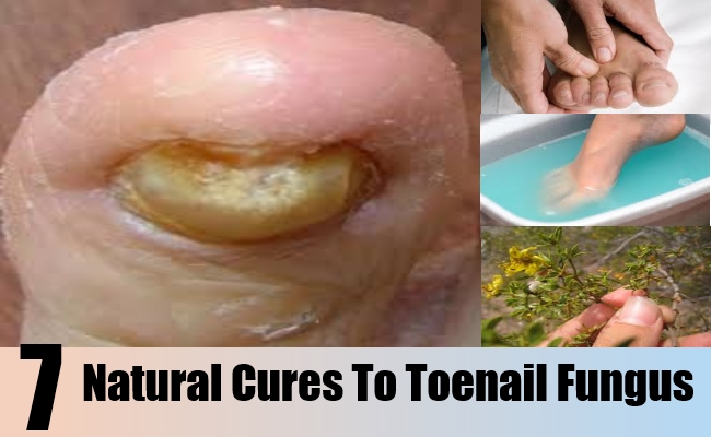 Natural Cure To Toenail Fungus